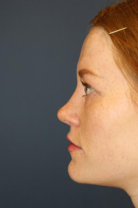 After image 3 Case #105356 - Rhinoplasty