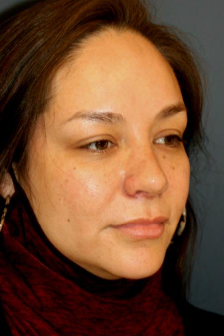 After image 2 Case #105496 - Rhinoplasty