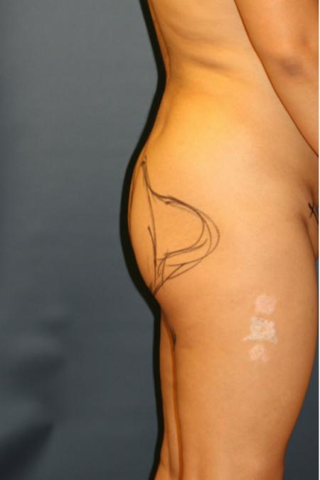 Before image 1 Case #105421 - Brazilian Buttock Lift (BBL)