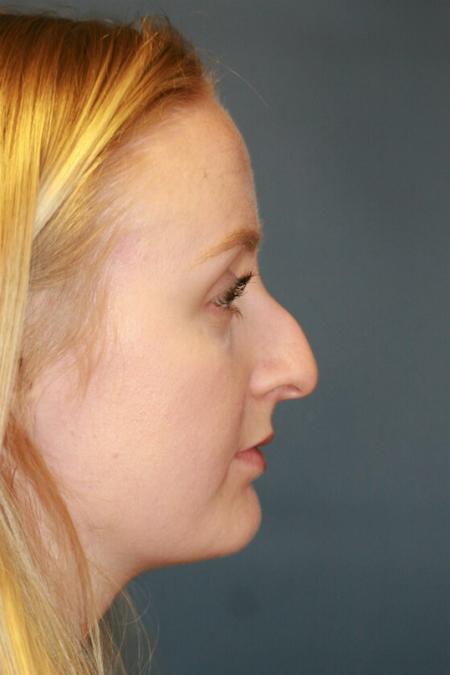 Before image 1 Case #105396 - Female Rhinoplasty