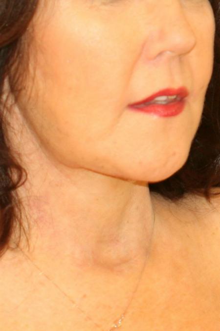 After image 2 Case #105481 - Female Neck Lift