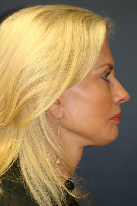 After image 3 Case #105406 - Comprehensive Facelift