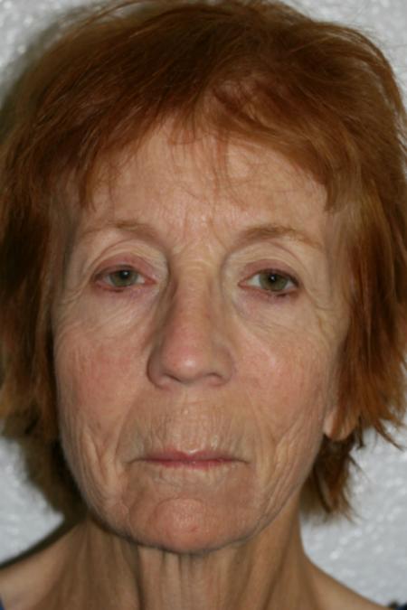 Before image 1 Case #105556 - Co2 Laser Skin Resurfacing