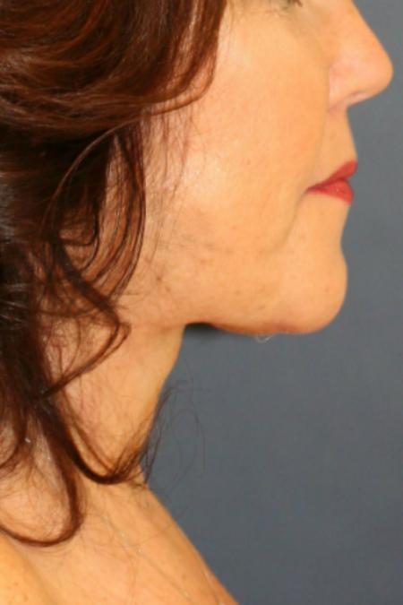 After image 1 Case #105481 - Female Neck Lift