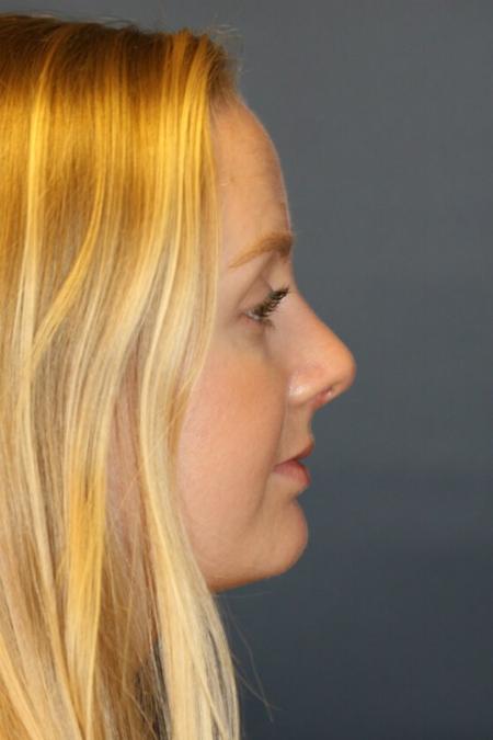 After image 1 Case #105396 - Female Rhinoplasty