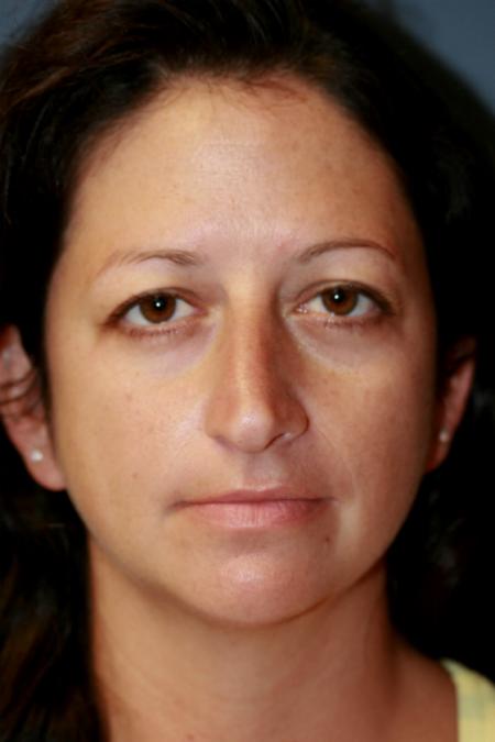 Before image 1 Case #105551 - Rhinoplasty