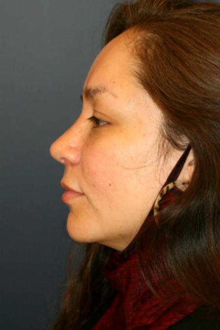 After image 3 Case #105496 - Rhinoplasty
