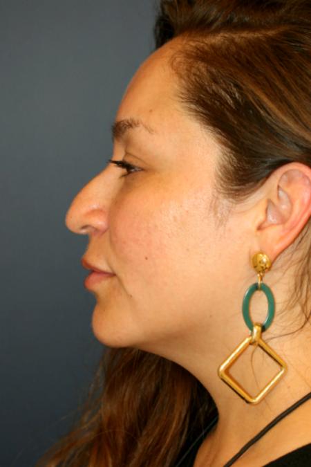Before image 3 Case #105496 - Rhinoplasty