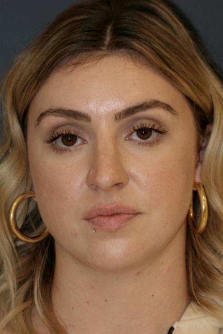 Before image 1 Case #106216 - Female Open Rhinoplasty