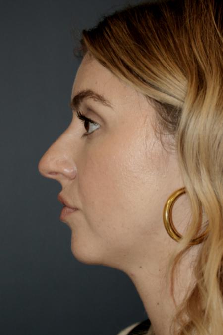 Before image 3 Case #106216 - Female Open Rhinoplasty