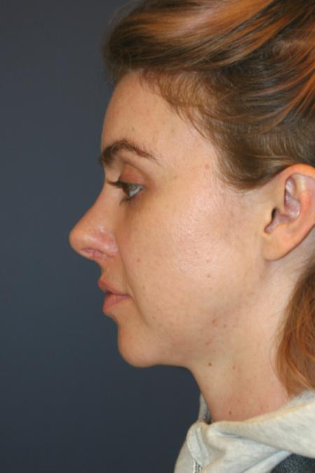 After image 3 Case #106216 - Female Open Rhinoplasty