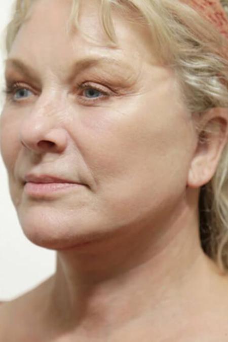 After image 2 Case #106591 - Female Total Face Rejuvenation