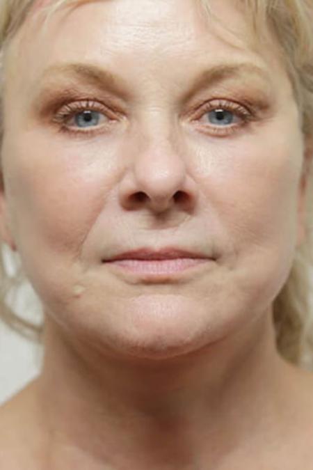 After image 1 Case #106591 - Female Total Face Rejuvenation