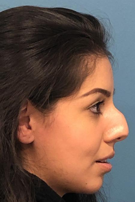 Before image 2 Case #107246 - Rhinoplasty