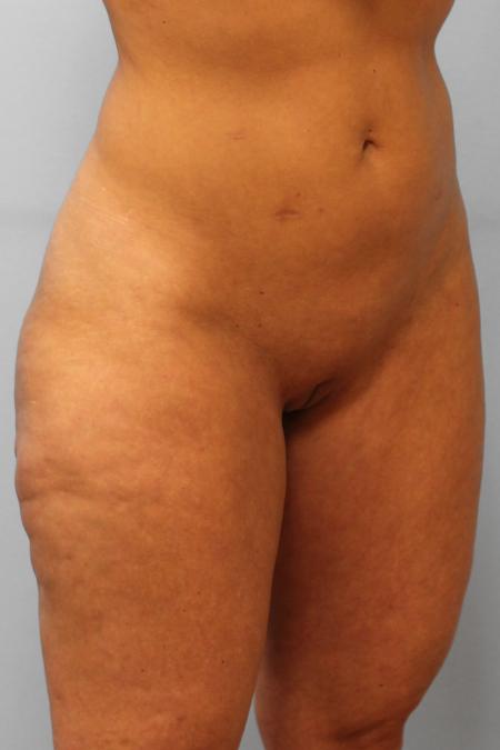 Before image 2 Case #107236 - Liposuction