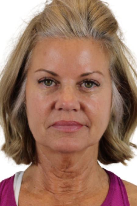 Before image 1 Case #107206 - The Deep Plane Face & Neck Lift