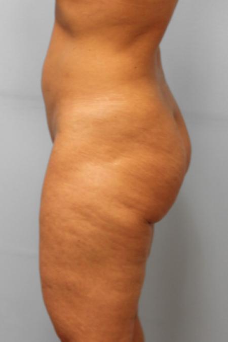 Before image 3 Case #107236 - Liposuction