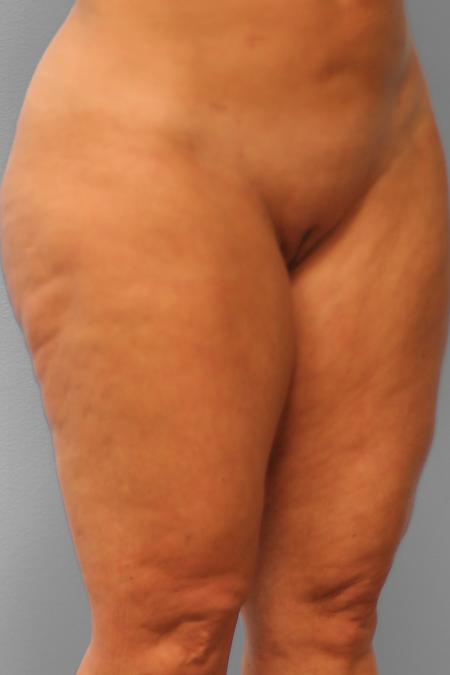 After image 2 Case #107236 - Liposuction