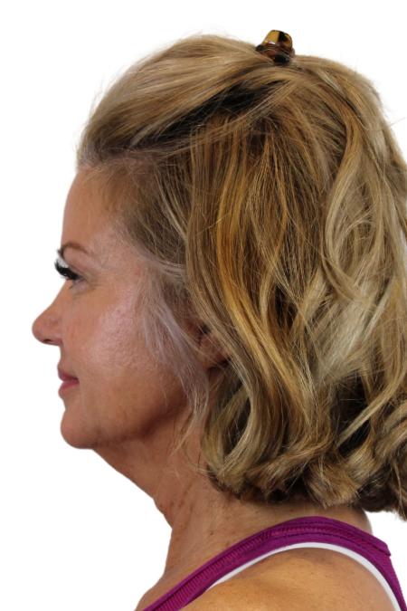 Before image 3 Case #107206 - The Deep Plane Face & Neck Lift