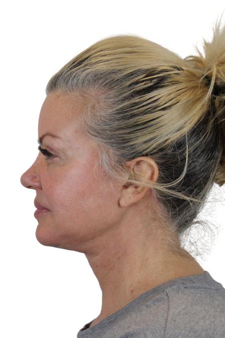 After image 3 Case #107206 - The Deep Plane Face & Neck Lift