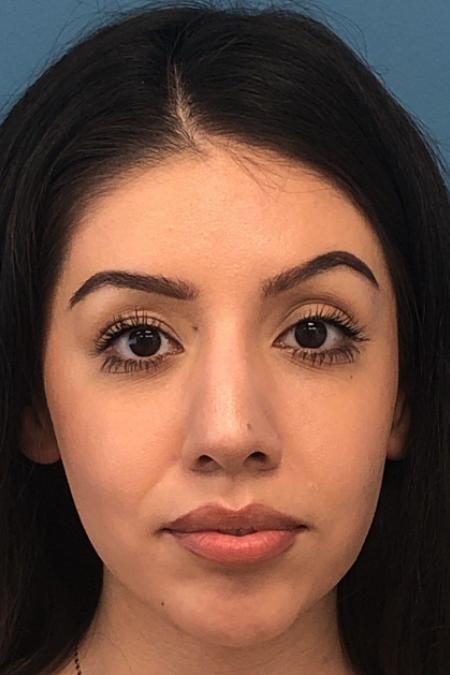 After image 1 Case #107246 - Rhinoplasty