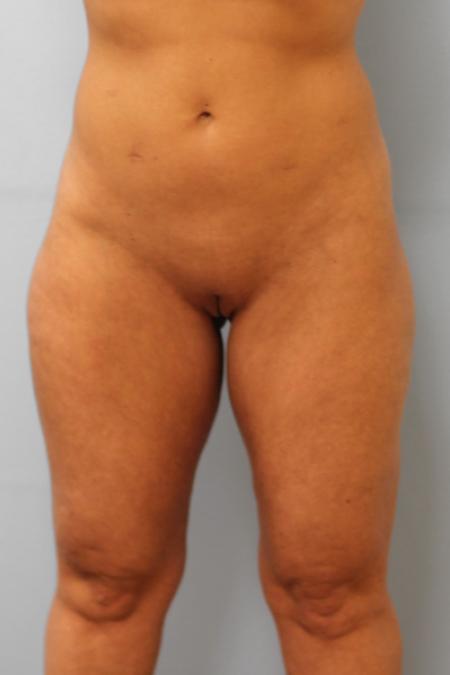 Before image 1 Case #107236 - Liposuction