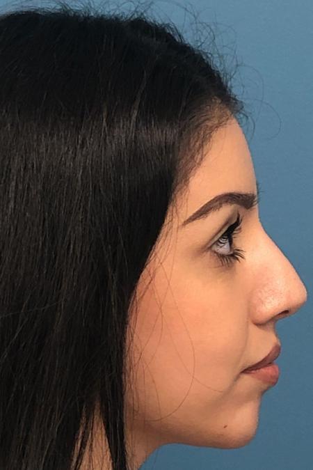 After image 2 Case #107246 - Rhinoplasty