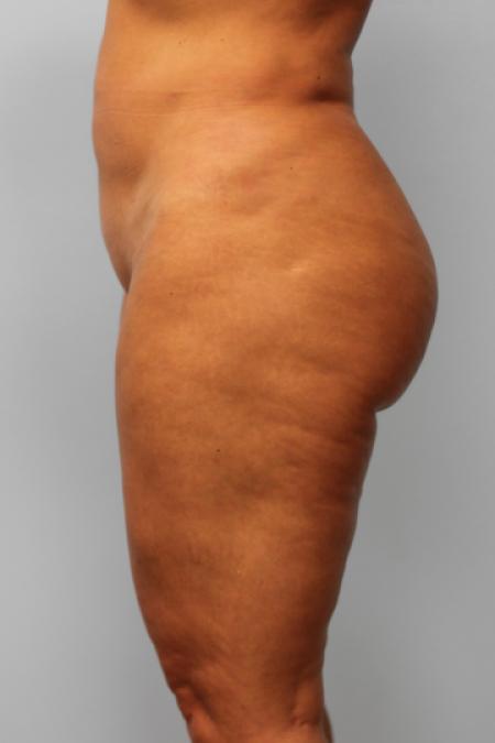 After image 3 Case #107236 - Liposuction