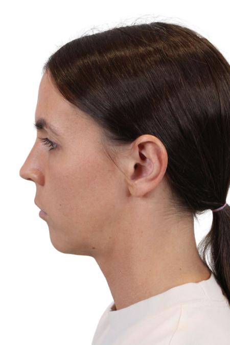 Before image 3 Case #107201 - 31 Year Old Deep Plane Face & Neck Lift