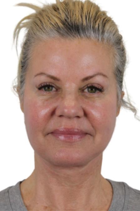 After image 1 Case #107206 - The Deep Plane Face & Neck Lift