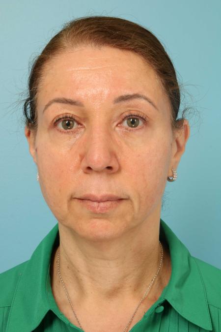 After image 1 Case #107466 - Blepharoplasty