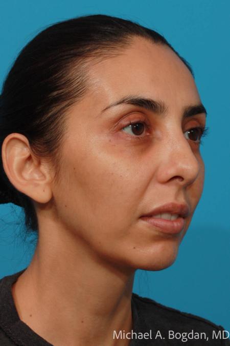 After image 2 Case #108301 - Chin Augmentation