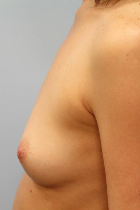 Before image 3 Case #107791 - Breast Augmentation
