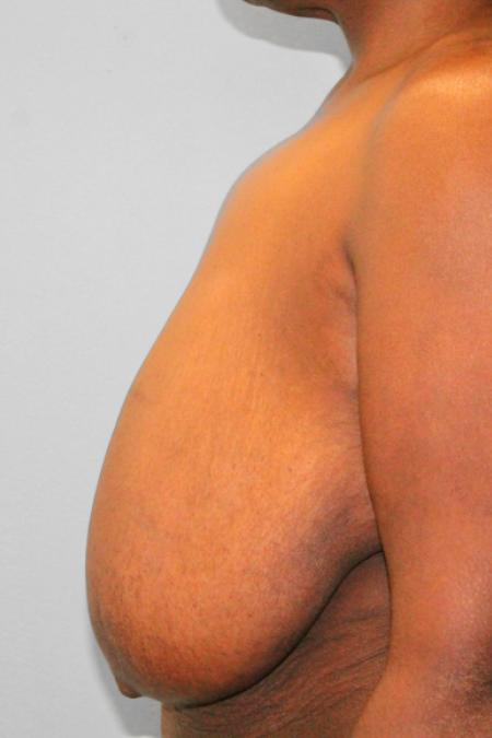 Before image 3 Case #108256 - Breast Reduction