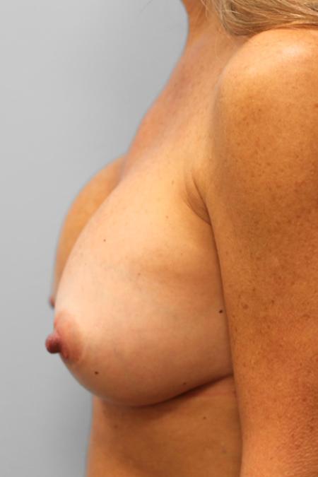 Before image 3 Case #107941 - Breast Revision