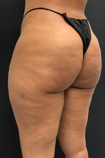 After Case #107906 - Avéli™ (Minimally Invasive Cellulite Reduction)