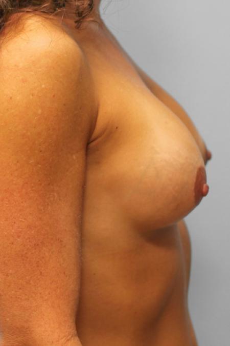 Before image 3 Case #108041 - Breast Revision
