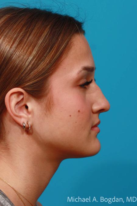 Before image 3 Case #108356 - Rhinoplasty