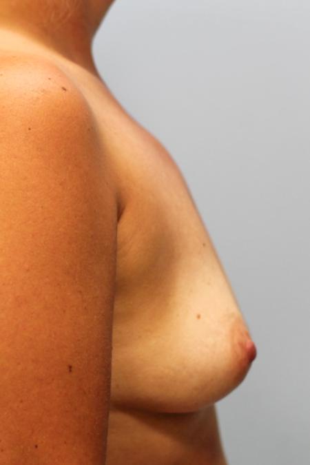 Before image 3 Case #107786 - Breast Augmentation
