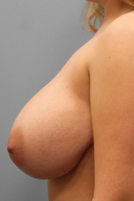 Before image 3 Case #107806 - Breast Reduction