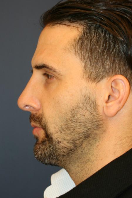 After image 1 Case #107641 - Rhinoplasty with Chin Implant