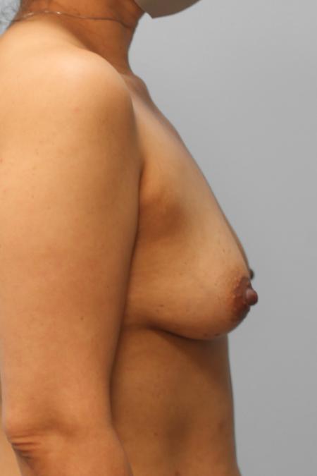 Before image 3 Case #107996 - Breast Augmentation