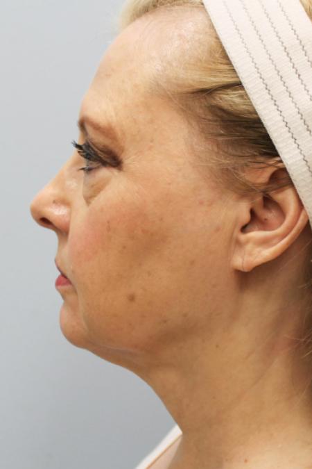 Before image 3 Case #108151 - Facelift & Blepharoplasty