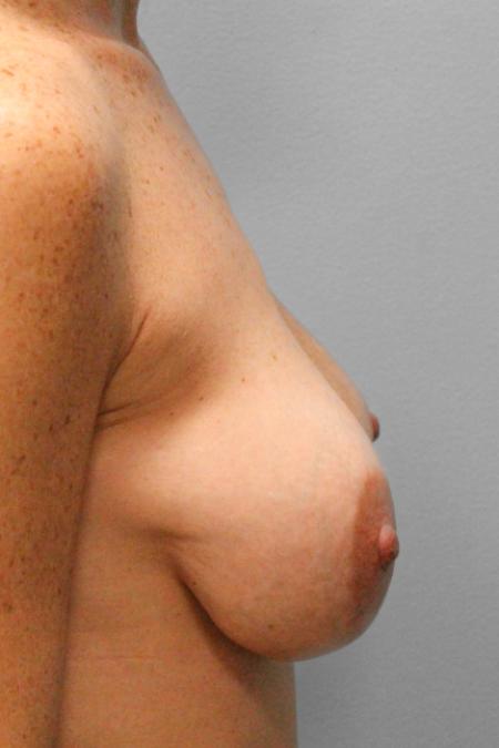 After image 3 Case #107726 - Implant Exchange