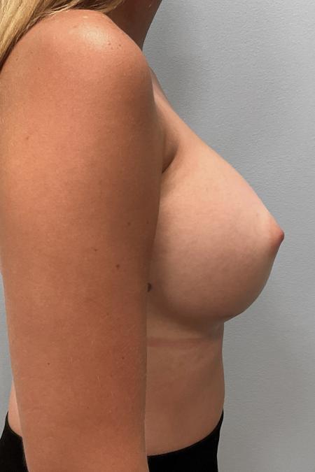 After image 3 Case #107976 - Breast Augmentation