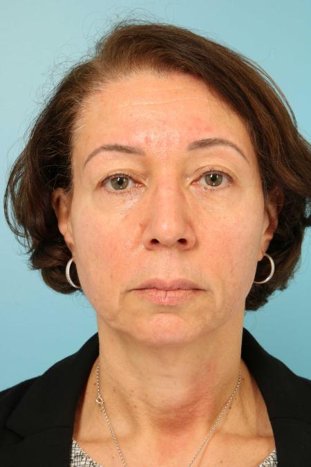 Before image 1 Case #107466 - Blepharoplasty