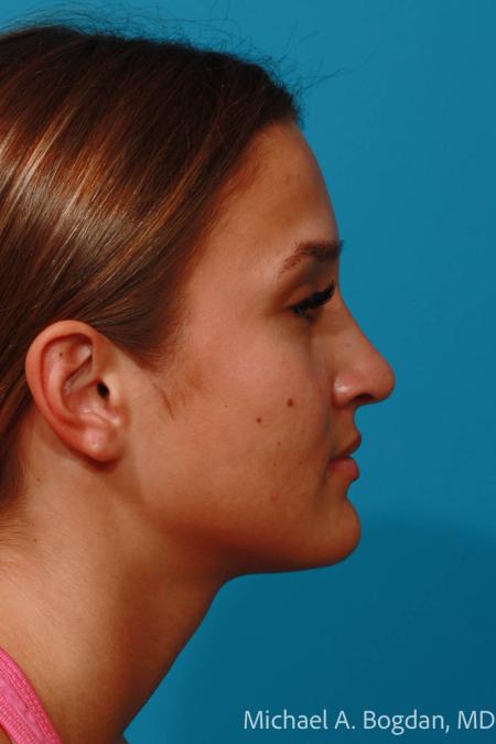 After image 3 Case #108356 - Rhinoplasty