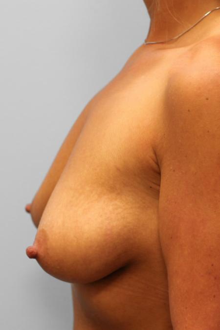 Before image 3 Case #107956 - Breast Augmentation