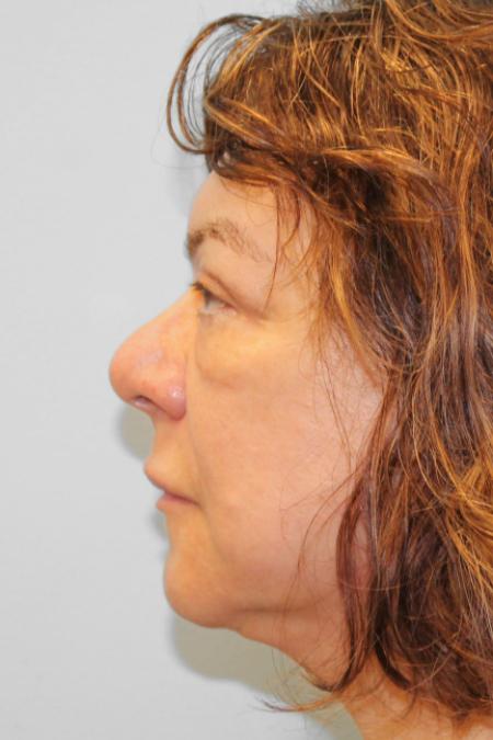 After image 3 Case #107686 - Facelift