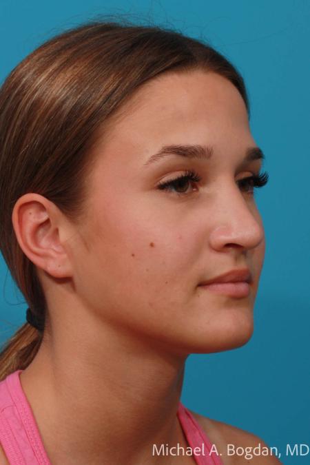 After image 2 Case #108356 - Rhinoplasty